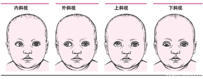 斜视的分类